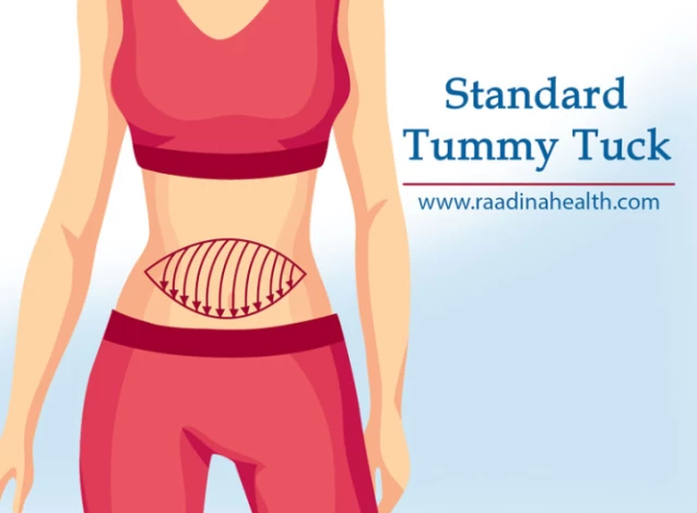 What are the different types of tummy tucks?