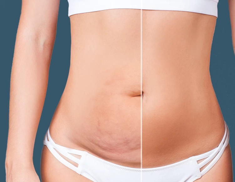 Comparing Liposuction vs. Tummy Tuck: Results, Pictures, Cost & More  (Updated 2024)