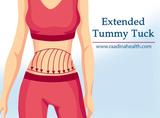 Extended Abdominoplasty (Tummy Tuck)