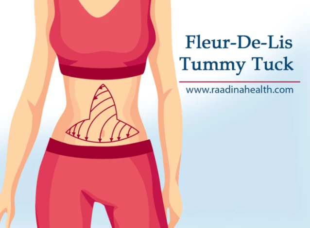 Fleur-De-Lis Abdominoplasty: Tighten and Contour Your Tummy