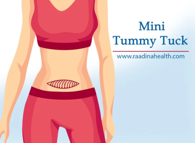 What Is Mini Tummy Tuck? + [Mini vs Full Tummy Tuck] - Raadina Health
