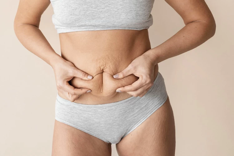 Tummy Tuck Scars: Position, Healing, and Treatment