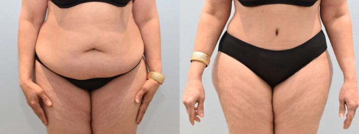 What Are The Different Types of Tummy Tuck Surgeries?