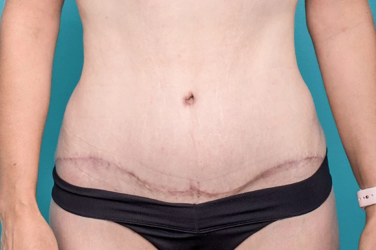What Is Reverse Tummy Tuck & How Does it Work? - Raadina Health