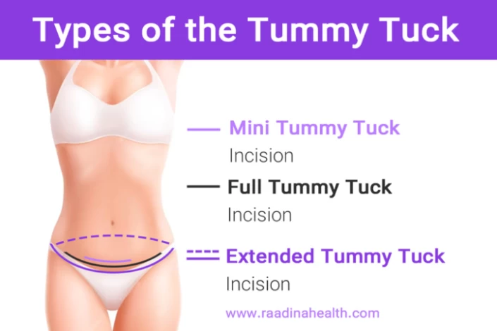 Full vs. Mini Tummy Tuck