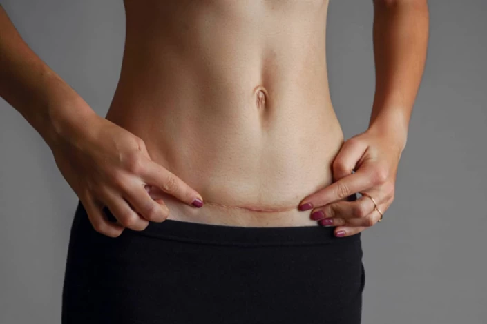 What does a tummy tuck scar look like?