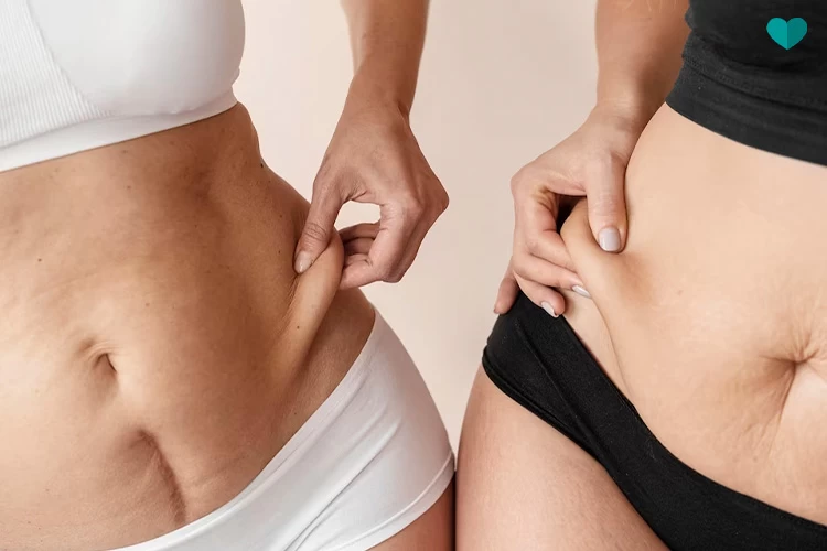 A reverse tummy tuck is a procedure that improves the appearance of the upper abdomen.