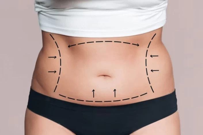 What Is Reverse Tummy Tuck & How Does it Work? - Raadina Health