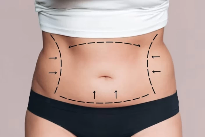 ✨WHAT IS IT?: Reverse Tummy Tuck✨ A reverse abdominoplasty (reverse tummy  tuck) is chosen for the individual who has loose excess skin in the  upper