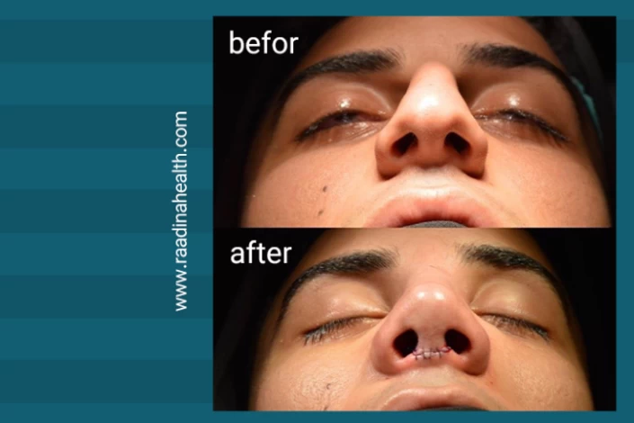 Types of Noses by Race - Raadina Health