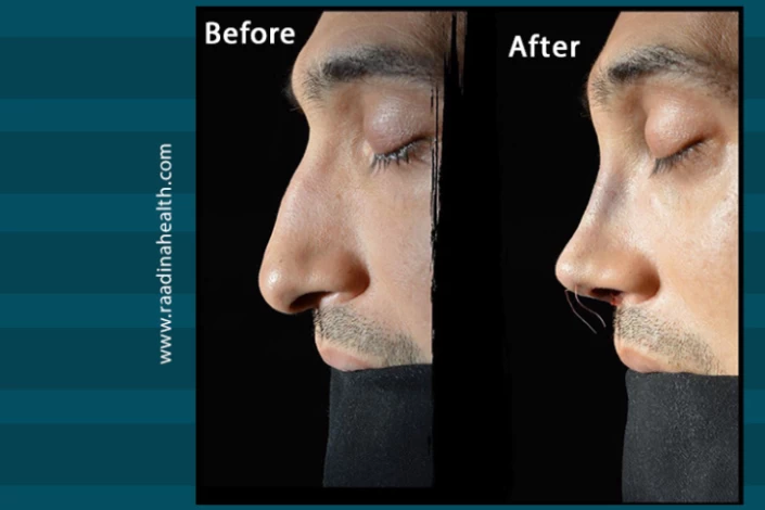 Types of Noses by Race - Raadina Health