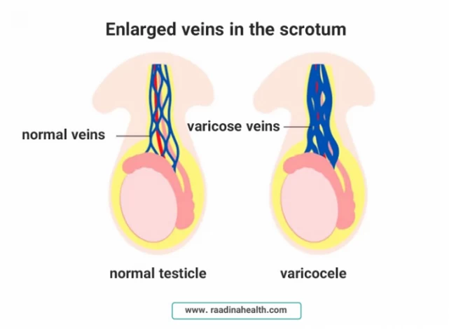 Grade 3 Varicocele Symtoms & Treatments - Raadina Health