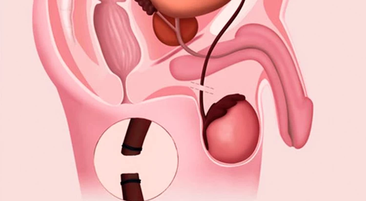 عمل جراحی وازکتومی (vasectomy)