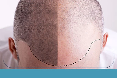 Hair Transplant Hair Transplant