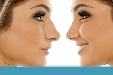 Nose Job