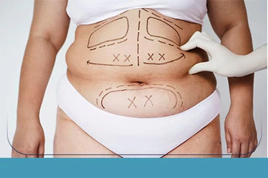 Liposuction Liposuction in Iran